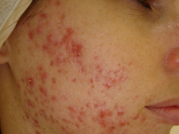 Acne and Treatment Options