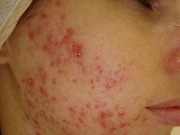 Best Acne Scar Treatment in Hyderabad