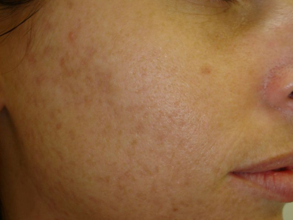 Best Treatment For Acne Scars and Dark Spots