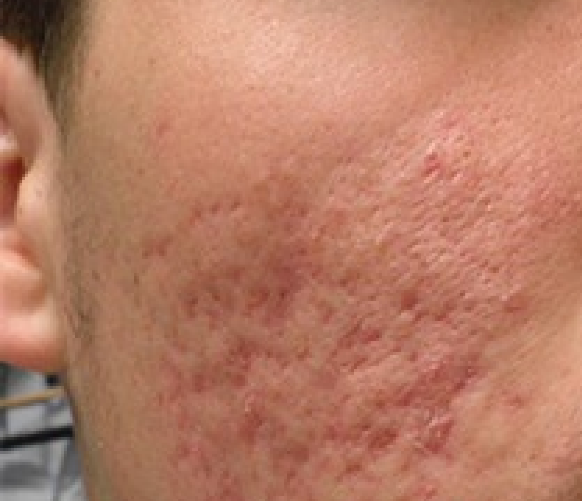 treatment of acne scars
