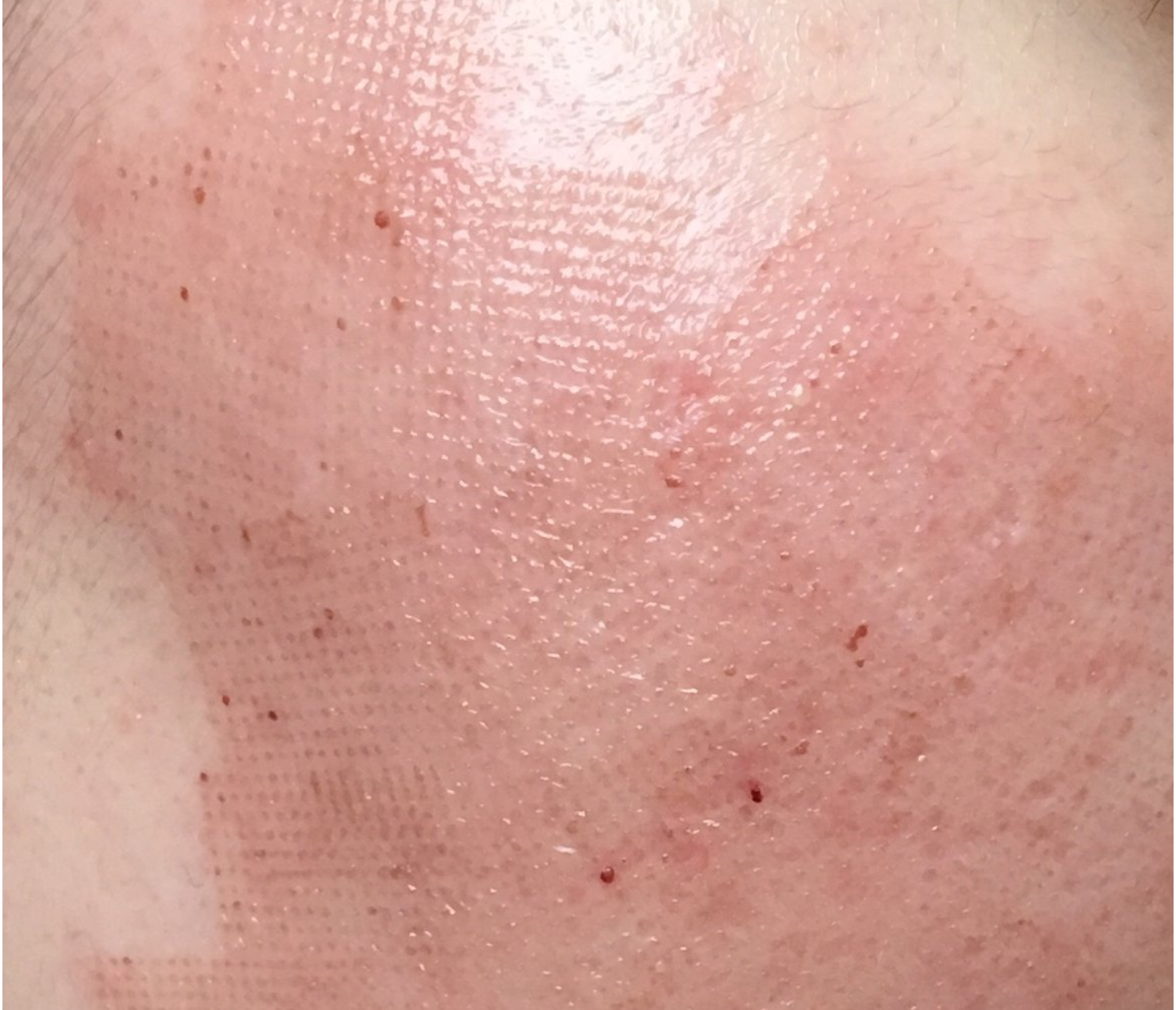 RF Microneedling