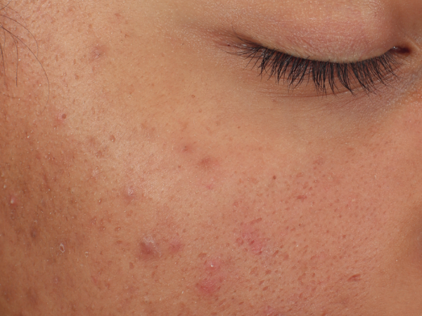 Best Dermatologist in Hyderabad For Acne