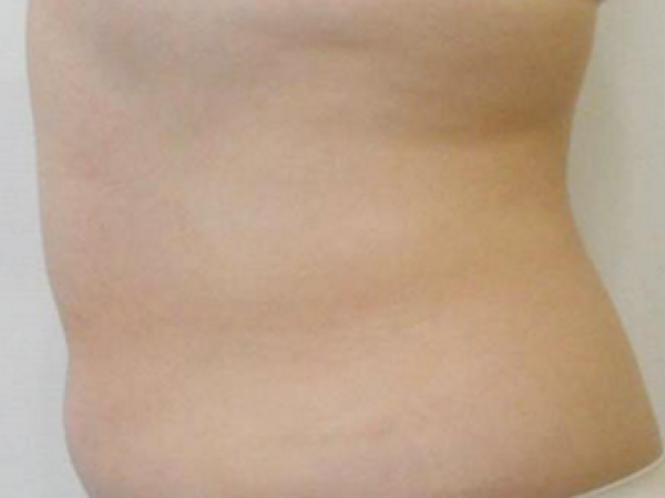 Body Contouring Treatment, body contouring surgery