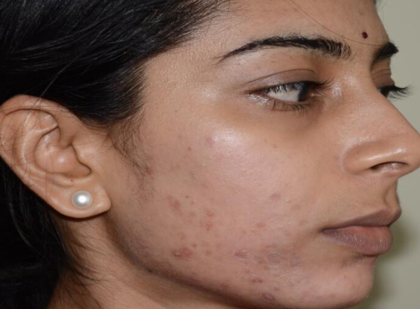 Skin Pigmentation Reduction