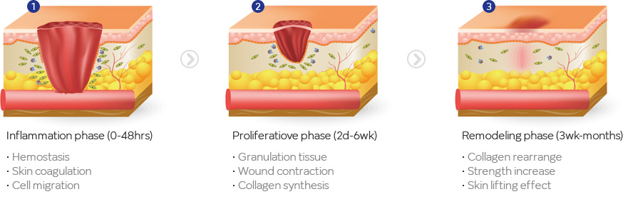 High Intensity Focus Ultra Sound