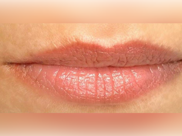 Lip Augmentation Doctors in Hyderabad