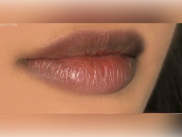 Lip Augmentation in India