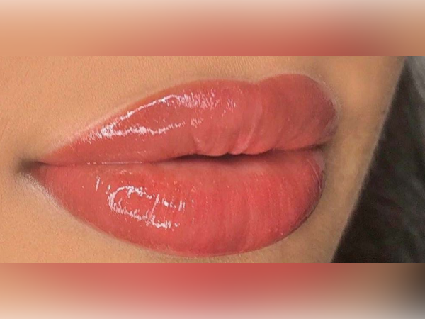 Permanent Lip Augmentation treatment