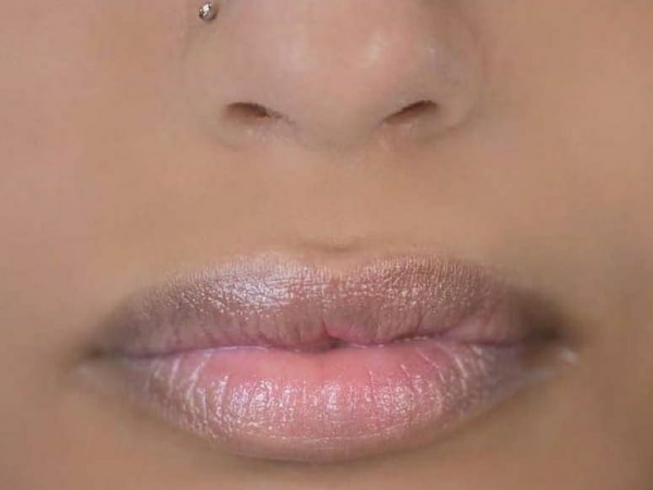 Lip Augmentation