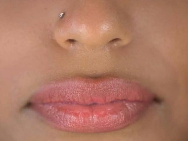 Lip Augmentation