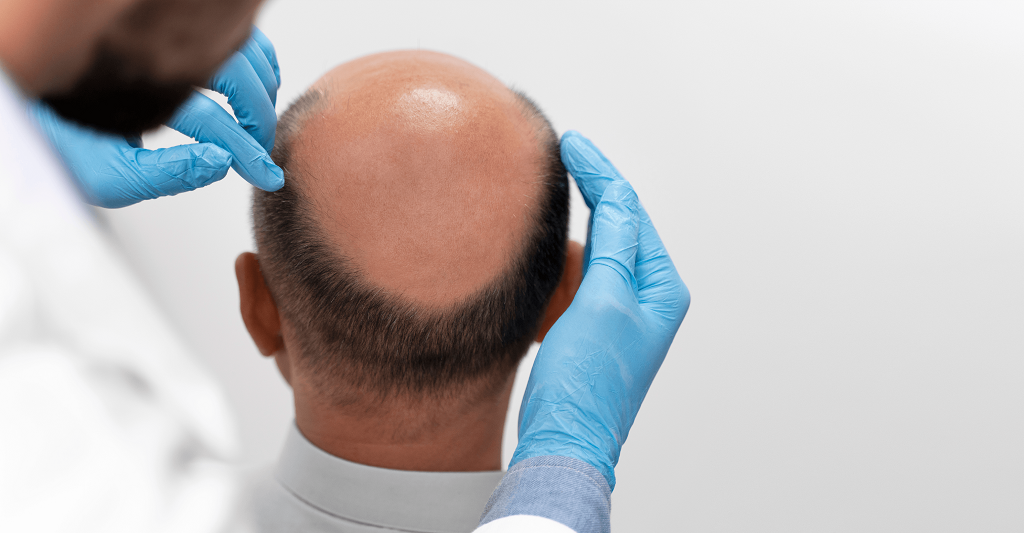 Hair Transplant for Women & Men: Restoring Confidence and Natural Beauty