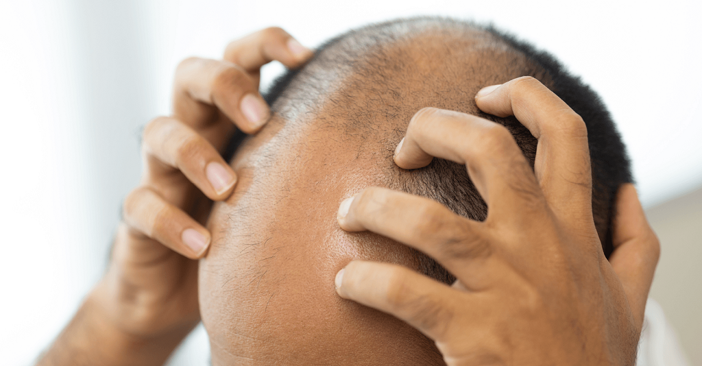Restoring Confidence: Top-rated Hair Transplant Solutions for Receding Hairline