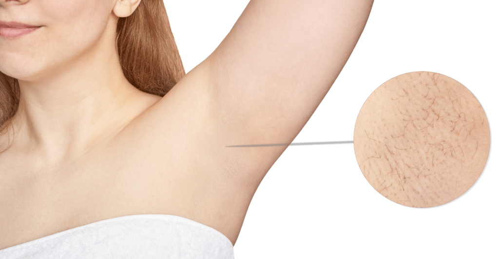 Electrolysis Hair Removal: A Permanent Solution to Unwanted Hair