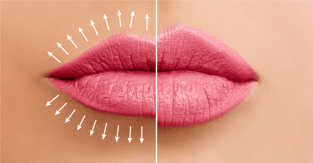Enhancing Your Smile: How Lip Fillers Can Transform Your Lips