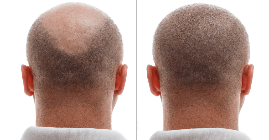 Unlocking the Secrets of a Successful Donor Area for Hair Transplant
