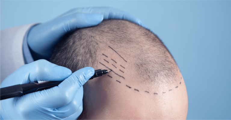 What To Consider While Choosing a Hair Transplant Clinic?