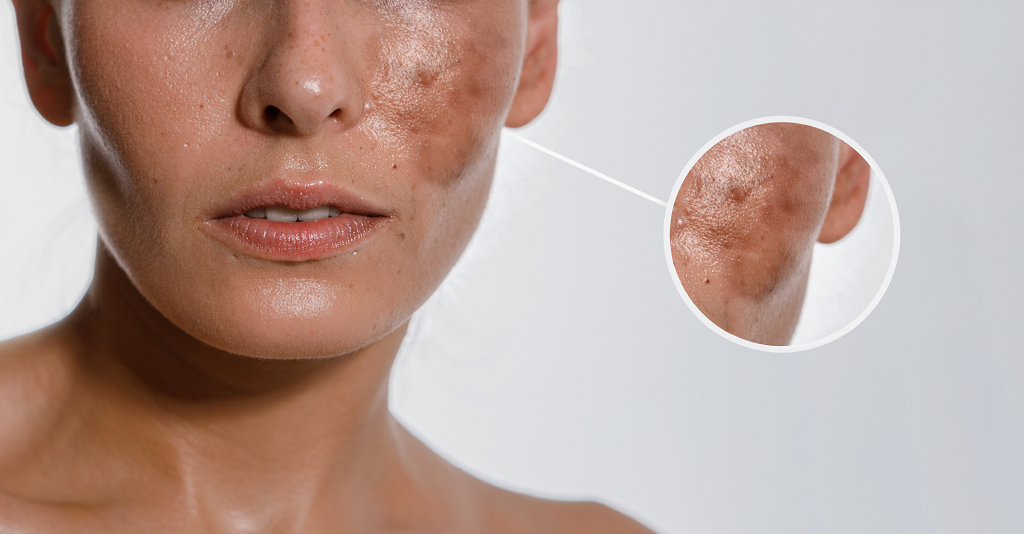 Why Does Acne Cause Hyperpigmentation - Sasha Clinics