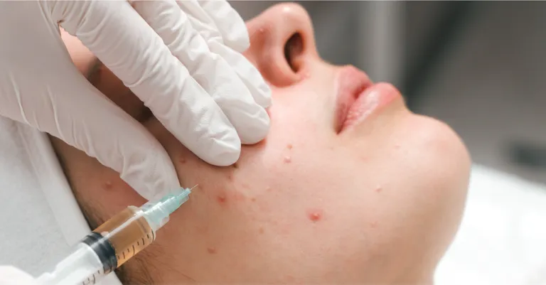 Bacterial Acne vs Hormonal Acne - What You Need to Know - Sasha Clinics