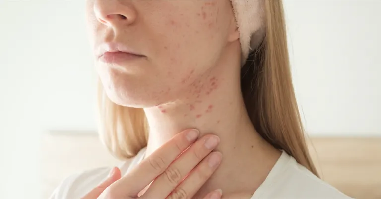 How Hormonal Imbalance in PCOS Can Cause Cystic Acne?