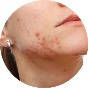 ACNE SCAR