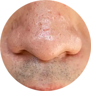 OPEN PORES