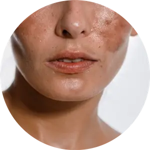 MELASMA