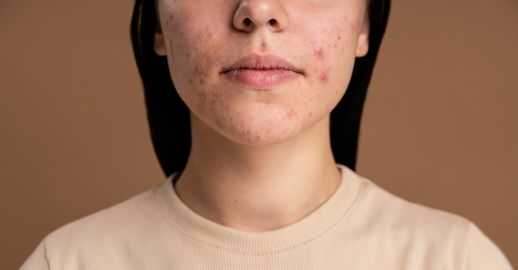 Everything to Know About Fillers for Acne Scars - Sasha Clinics