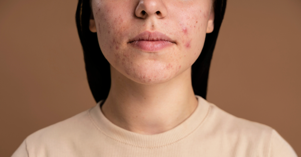 Acne Scars 101:  A Comprehensive Guide for Silky Smooth Skin
