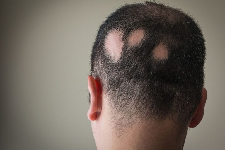 Is it possible to regrow hair on bald spots naturally?