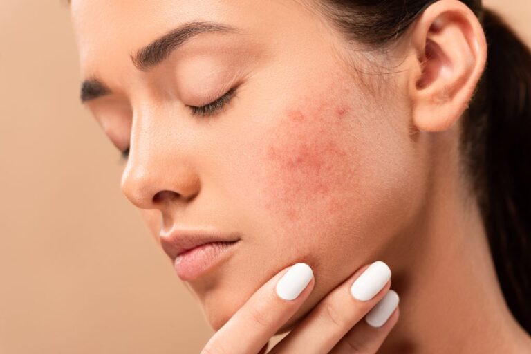 How to remove acne marks?