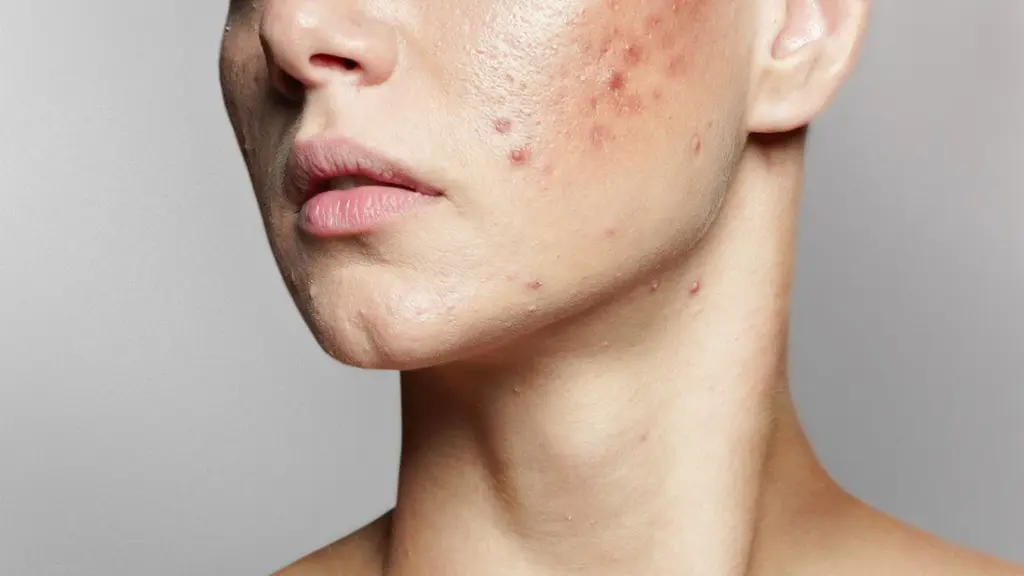 Say Goodbye to Blemishes | The Ultimate Guide to Treating Acne, Scars, and Dark Spots