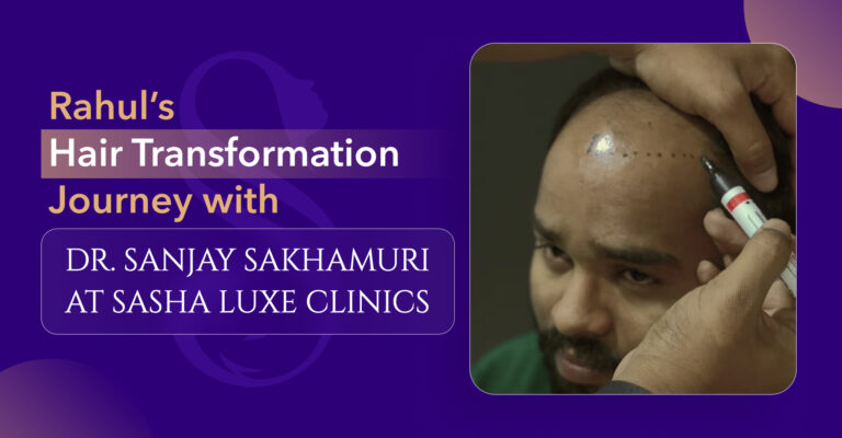 Rahul’s Hair Transplant Journey at Sasha Luxe Clinics : Restoring Confidence with Expertise